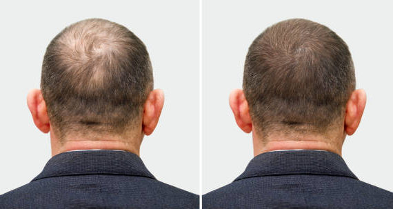 Greffe de cheveux à Paris