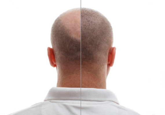 Greffe de cheveux à Paris