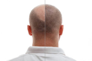 greffe de cheveux à Paris