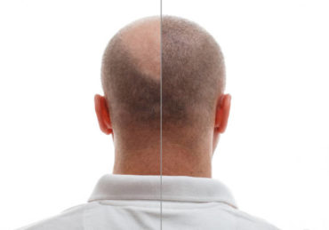 greffe de cheveux à Paris